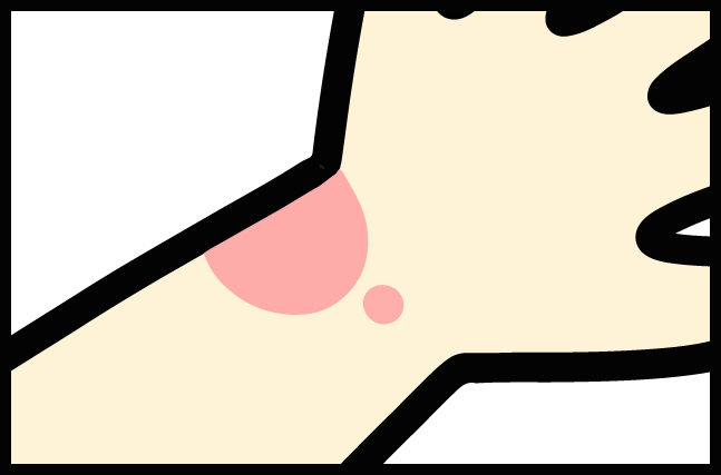 アトピーで肌が赤い